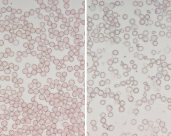 #GRANTWINNERS: un nuovo possibile approccio per curare la beta-talassemia