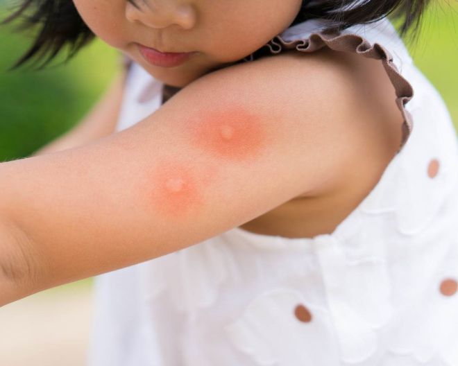 Perché le zanzare pungono solo alcune persone? Lo spiega il dermatologo