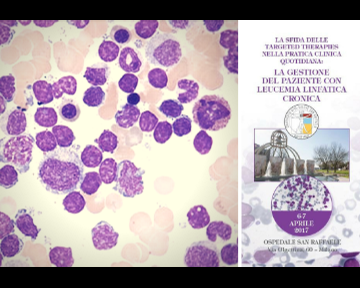 Corso “La sfida delle Targeted Therapies nella pratica clinica quotidiana: la gestione del paziente con leucemia linfatica cronica”