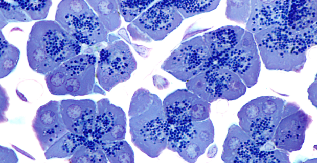 Tumore al pancreas: nuove linee guida grazie a uno studio finanziato da pazienti
