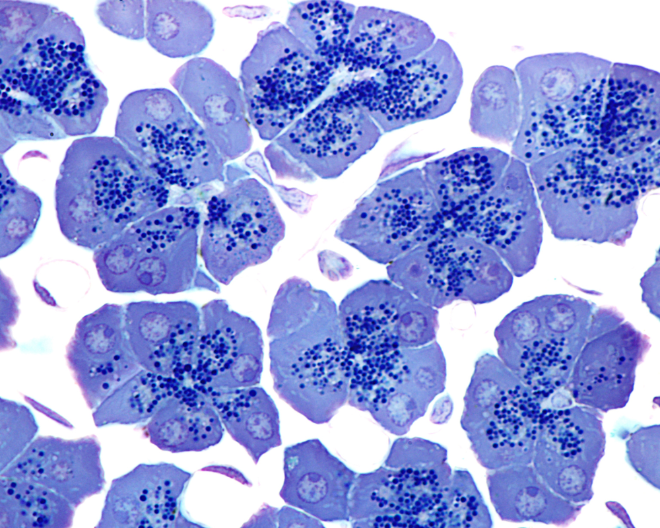 Pancreatic Cancer: New Treatment Guidelines Arising from a Patient-Funded Study