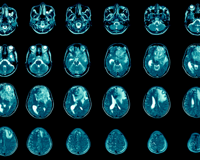 Una nuova piattaforma di terapia genica per il glioblastoma multiforme